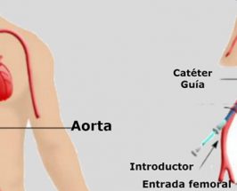 5 pasos para un cateterismo diagnóstico