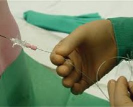 Set de anestesia epidular